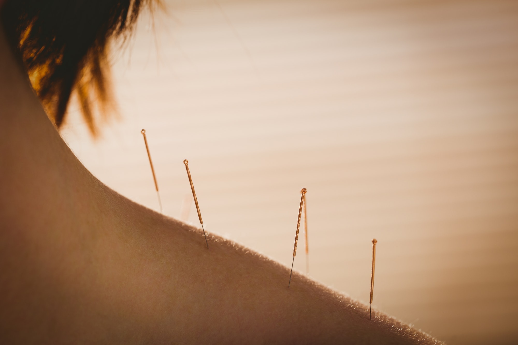 Young woman getting acupuncture treatment in therapy room