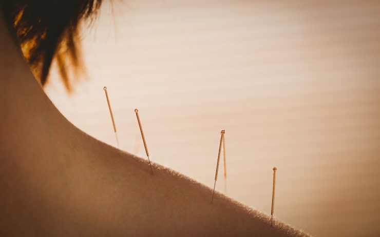 Young woman getting acupuncture treatment in therapy room